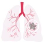 Hydatid Cysts Treatments in India