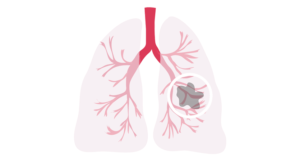 Hydatid Cysts Treatments in India